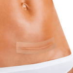 لصقة سيليكون لعلاج الندبات Deramed